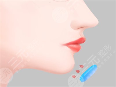 磨颧骨+下颌手术果对比图 真实感受分享 