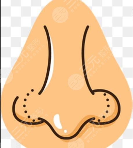 西安西京医院假体隆鼻手术一个月过程恢复对比图分享实录