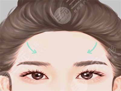 隆额头多久恢复自然？自体脂肪隆额头果对比，恢复过程分享