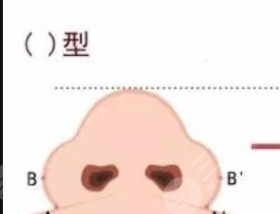 鹰钩鼻矫正整形手术真人案例 鹰钩鼻矫正多少钱