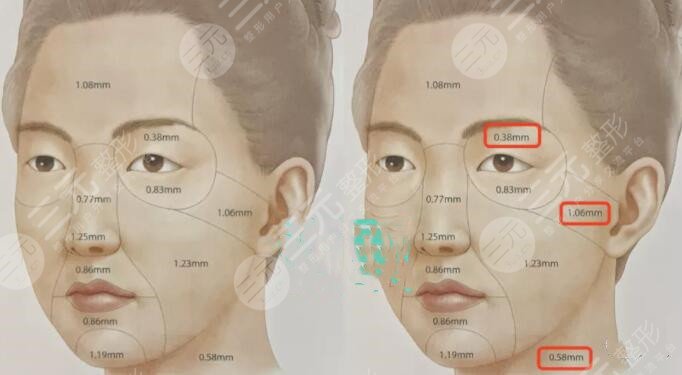 除皱美容手术降低风险吗?