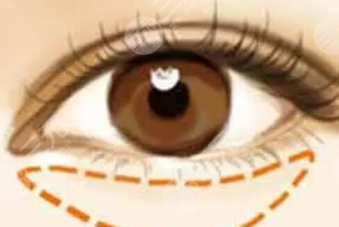 被眼袋困扰多年忍无可忍做手术去除