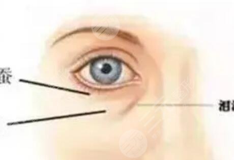 被眼袋困扰多年忍无可忍做手术去除