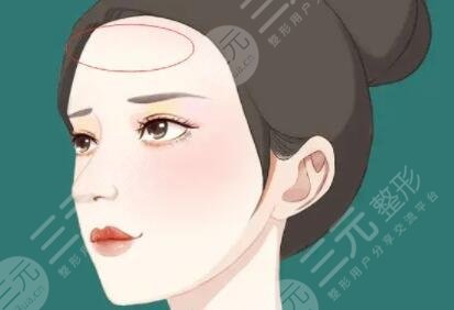 自体脂肪面部填充后四个月果图分享