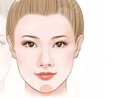 面部轮廓整形+下巴整形带来360度无死角小脸