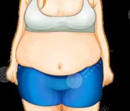 怎么减肚子上的赘肉 腰腹部吸脂20天之后