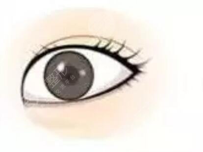 切开割双眼皮手术一个月恢复过程分享,还有大量前后对比图哦~