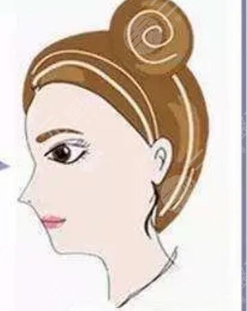 男神,分享,自体脂肪,丰面颊,垫下巴,手术,过程,对比图