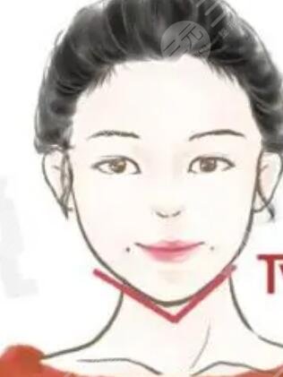 人造酒窝,整形,手术,恢复,过程,前后,果,对比图