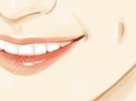 人造酒窝,手术,好不好,恢复,过程,前后,对比图