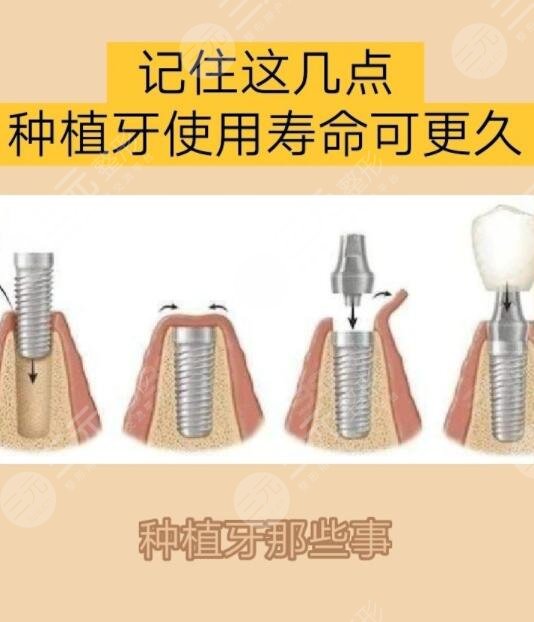 种植牙可以用多久寿命