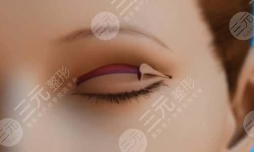 割双眼皮后1-7天恢复图