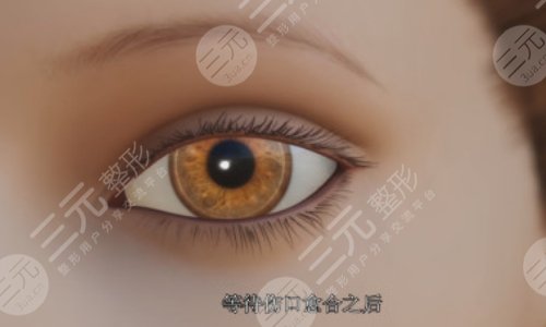 割双眼皮后1-7天恢复图