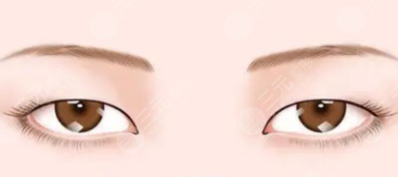 成都米兰柏羽三点式双眼皮恢复过程|内附前后对比图
