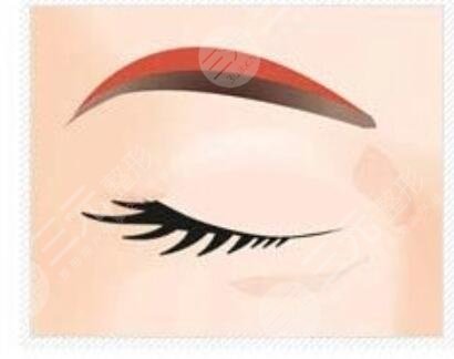 切眉手术1-7天的前后对比图,恢复过程没有什么后遗症出现