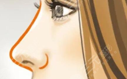 长沙美研孔伟立医生怎么样?综合隆鼻手术案例分享~