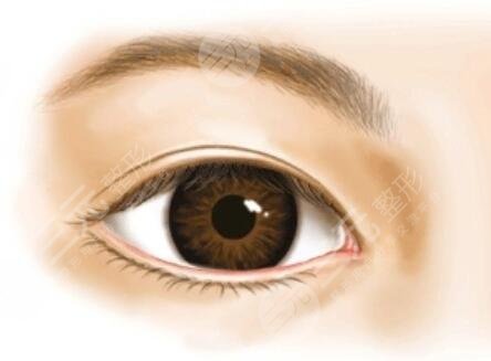 切开双眼皮和开内眼角双眼皮多项整形整形恢复过程案例
