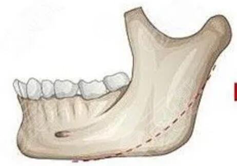 磨骨手术真实案例分享，磨骨手术6W元，磨骨整形前后对比照片