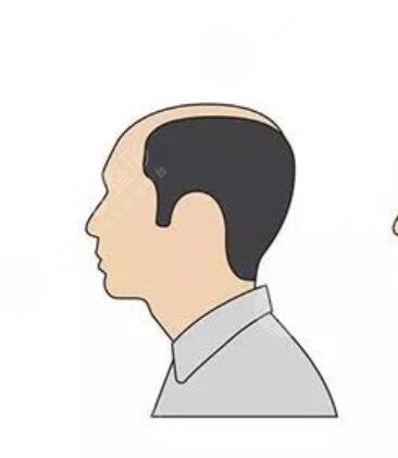 秃顶植发需要多少钱？植发医院做了植发对比图真实案例分享