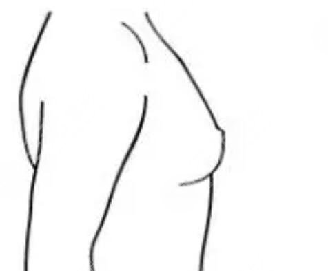 假体隆胸价格是多少？假体隆胸价格受什么因素影响?隆胸对比图