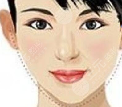 假体垫下巴恢复后