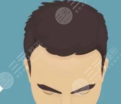 徐州雍禾植发医院发际线种植手术案例分享