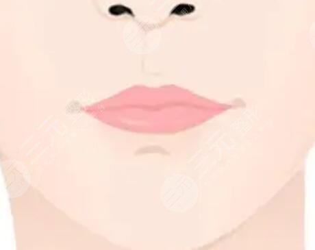 m唇手术恢复过程