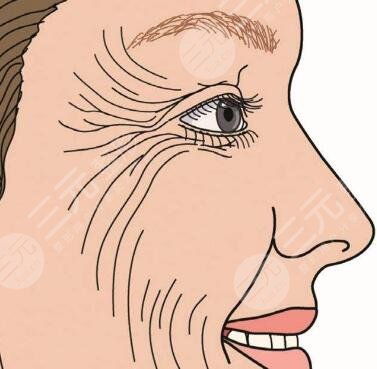 皮肤松弛做拉皮好还是做提升抗皱好?网友亲身经历分享:轻松get紧致肌肤~