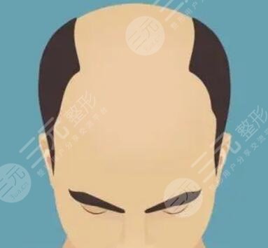 上海华山医院植发怎么样