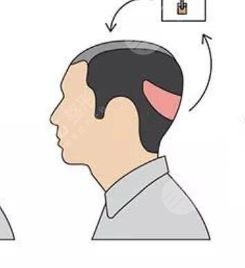 上海华山医院植发医生介绍