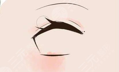 割双眼皮开眼角价格介绍和真人案例分享