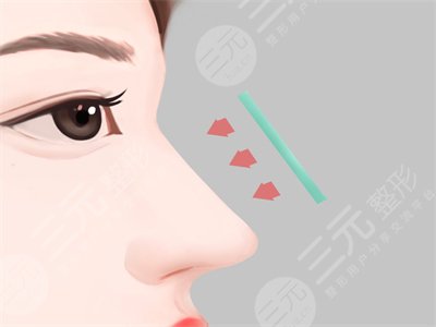 驼峰鼻的缓解|驼峰鼻整形前后果对比分享