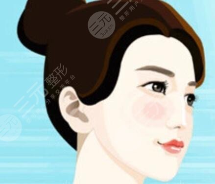 驼峰鼻的缓解|驼峰鼻整形前后果对比分享