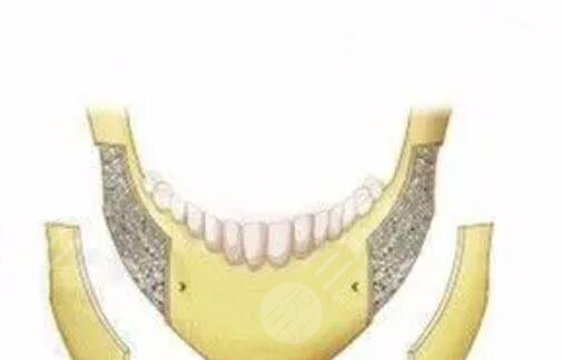 下颌角整形专家王韶亮真实案例|削骨对比照分享