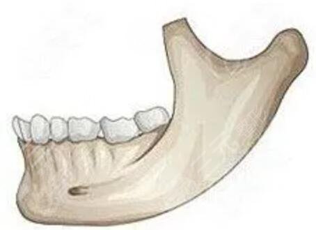 下颌角整形专家王韶亮真实案例|削骨对比照分享