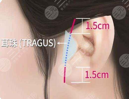 拉皮除皱多久看到果?