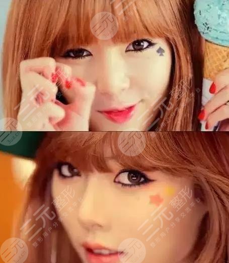 泫雅有没有动过脸?动了哪些地方?