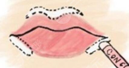 丰唇的方法