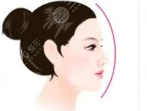 上海九院陈付国隆鼻修复案例:术后三个月恢复得更加好看