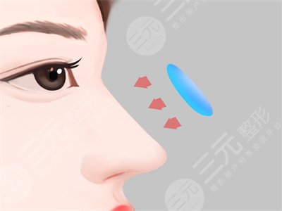 上海九院陈付国隆鼻修复案例:术后三个月恢复得更加好看