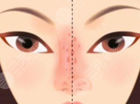 上海九院谢峰隆鼻案例，感觉换了个人更美了~