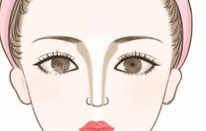 上海九院谢峰隆鼻案例，感觉换了个人更美了~