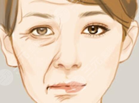 伊w兰去皱果怎么样？伊w兰去皱术后对比照1