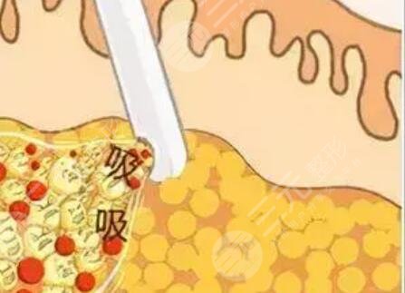 吸脂瘦脸