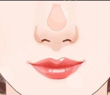 隆鼻整形手术果具体照片 手术前后对比果