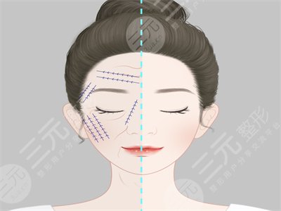 埋埋提升真人整形案例，面部对比果惊艳