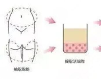 自体脂肪填充果反馈|成都美极整形如何？