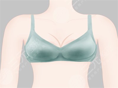 自体隆胸前后果对比|成都格莱丽整形反馈