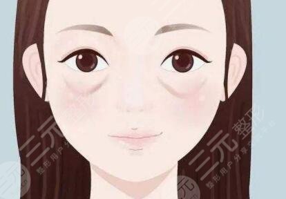 成都做去眼袋贵吗？附案例分享去眼袋果对比