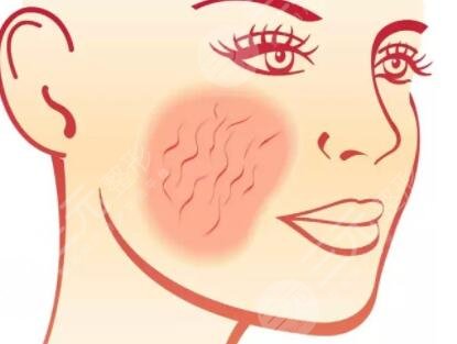 刚做完全脸脂肪填充感觉好丑,还好恢复后感觉是元气满满